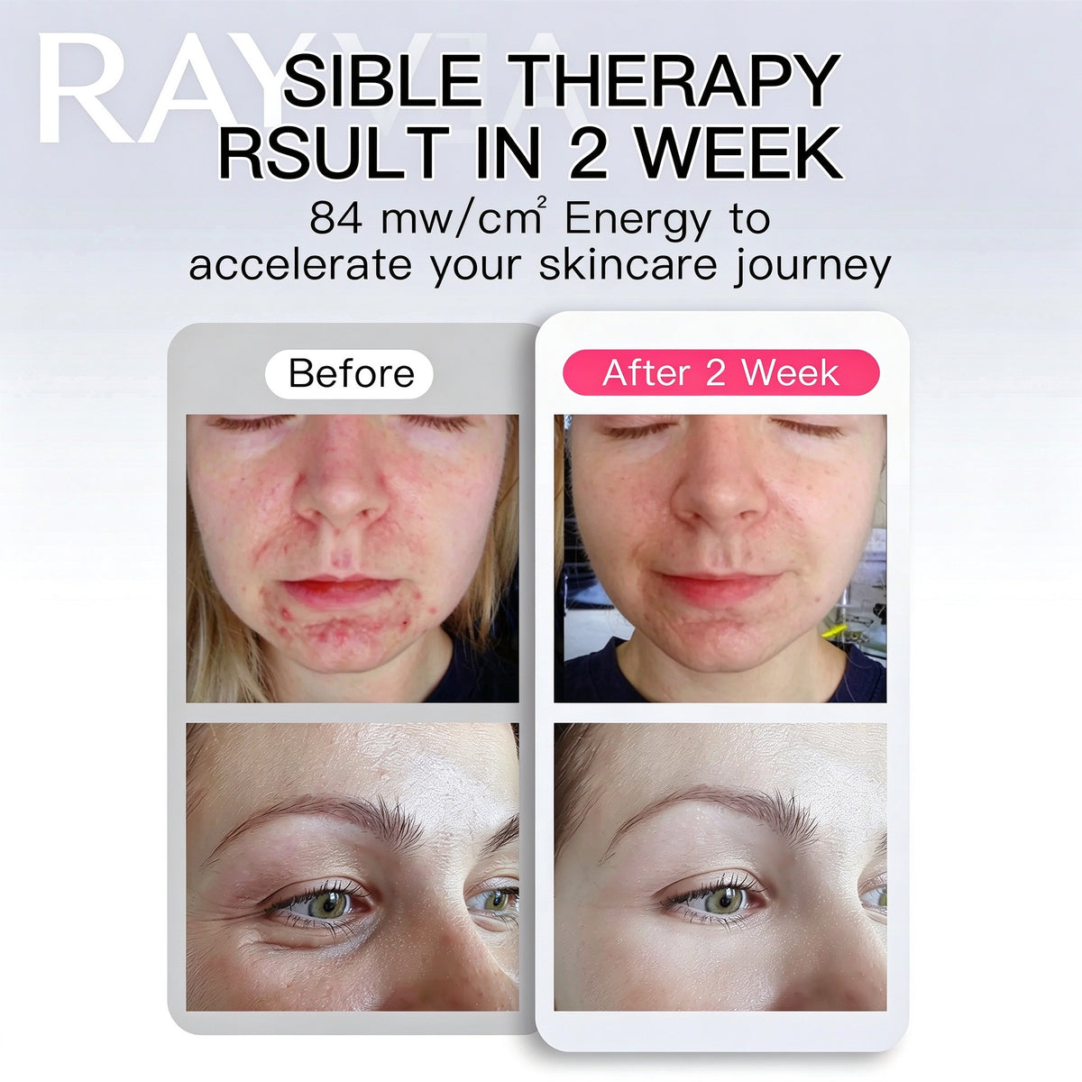 Rayvenia Glow LED Face & Neck Therapy Mask